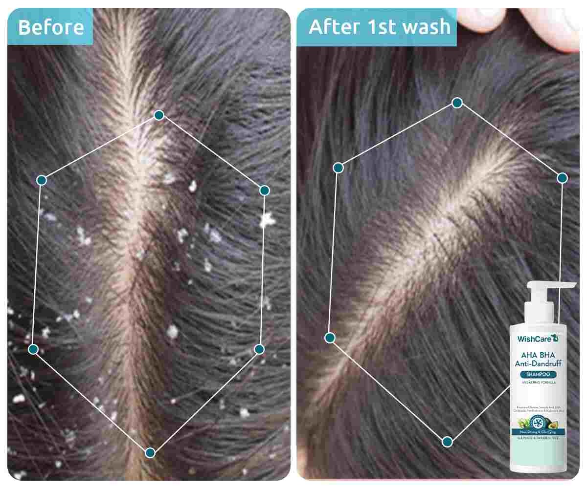WishCare AHA BHA Anti-Dandruff Shampoo (250ml)
