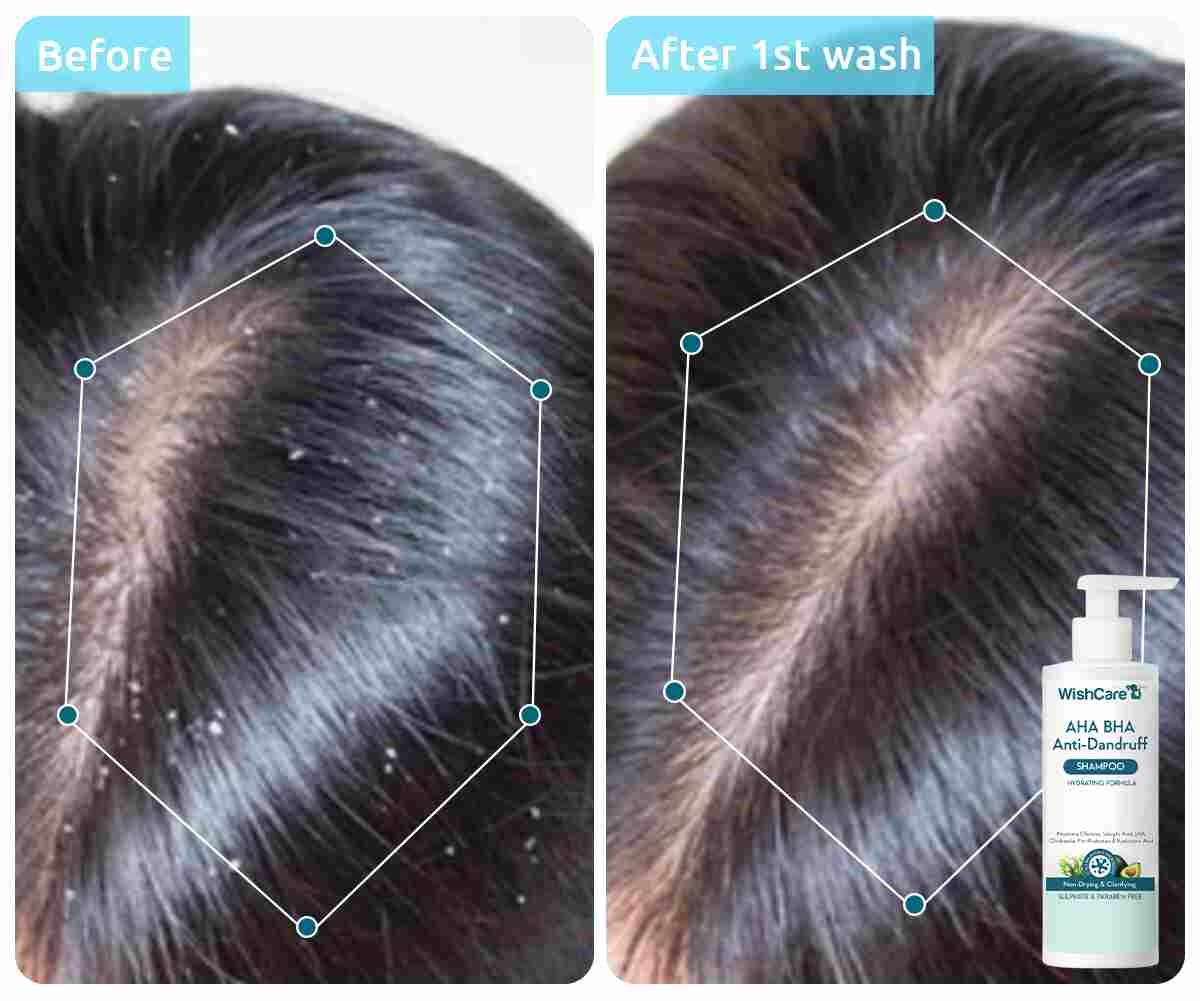 WishCare AHA BHA Anti-Dandruff Shampoo (250ml)